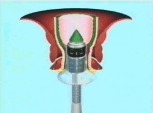 Engrapadora para hemorroides